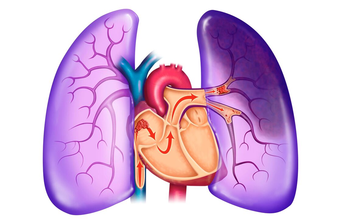 plaušu hipertensija
